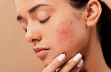 Comment effacer les cicatrices d'acné ? - Dr Marie Laure Pelletier ...
